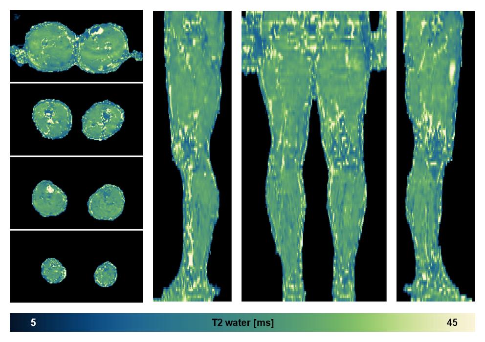 The water only T2 relaxation time of the lower extremity obtained from multi echo spin echo t2 mapping with EPG based reconstruction.